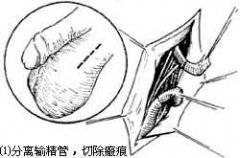 输精管炎症有什么症状表现